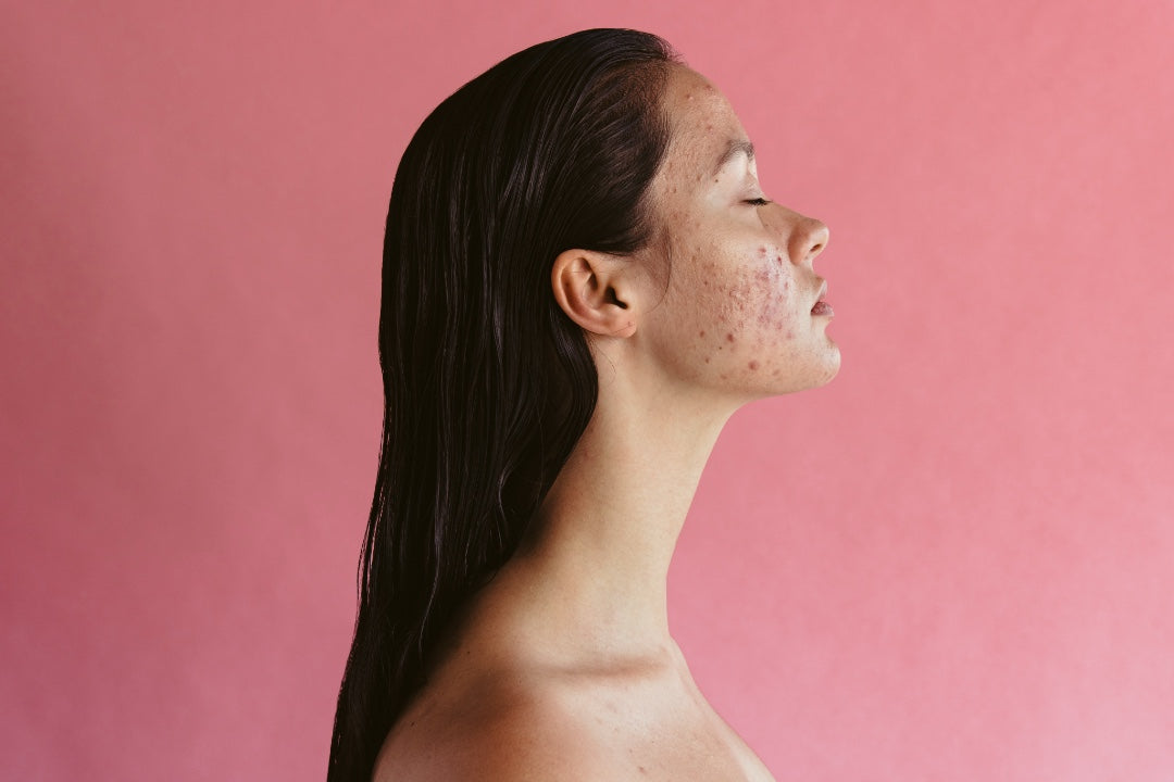 Acne Treatment Singapore: Adults' Guide to Clear Skin
