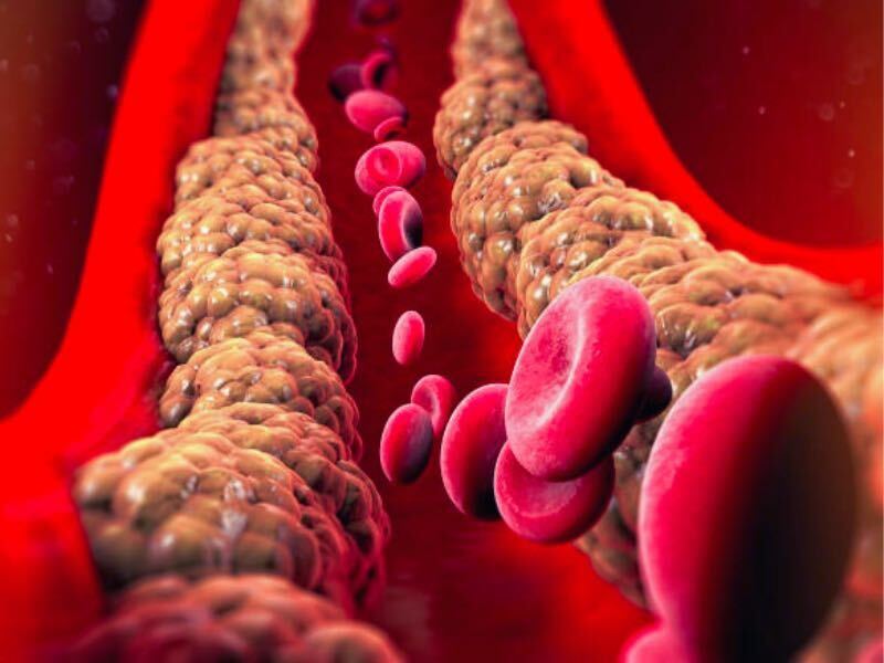How to Manage Cholesterol Levels to Prevent Stroke in Singapore